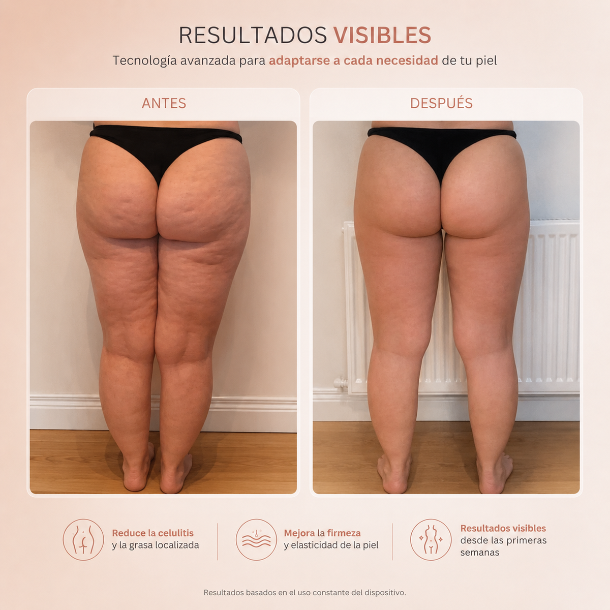 Rossety Sculpt RF™ | Anticelulitis Radiofrecuencia