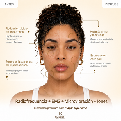 Rossety Face RF™ - Tratamiento Flacidez Facial